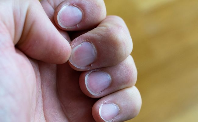 Comment arrêter de se ronger les ongles sans vernis amer