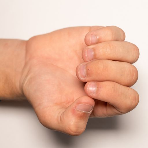 Ongles rongés – onychophagie